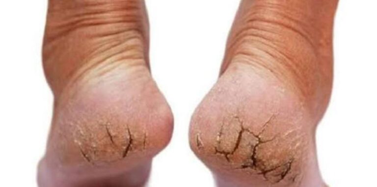 ಚಳಿಗಾಲದಲ್ಲಿ ಬಿರುಕು ಬಿಟ್ಟ ಹಿಮ್ಮಡಿಯನ್ನು ಗುಣಪಡಿಸಲು ಸಹಕಾರಿ ಈ ಮನೆಮದ್ದುಗಳು!