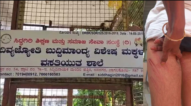 ಬುದ್ಧಿಮಾಂದ್ಯ ಬಾಲಕನ ಮೇಲೆ ರಾಕ್ಷಸಿ ಕೃತ್ಯ: ಬೆಲ್ಟ್ ಮತ್ತು ಪೈಪ್’ನಿಂದ ಹೊಡೆದು, ಕಣ್ಣಿಗೆ ಖಾರ ಹಾಕಿದ ಪಾಪಿಗಳು!