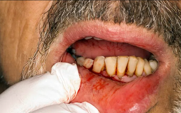 ಒಸಡುಗಳಲ್ಲಿ ರಕ್ತ ಬರುವುದು ಡಯಾಬಿಟಿಸ್ ಬರುವ ಮುನ್ಸೂಚನೆಯೇ? ಇಲ್ಲಿದೆ ಉತ್ತರ