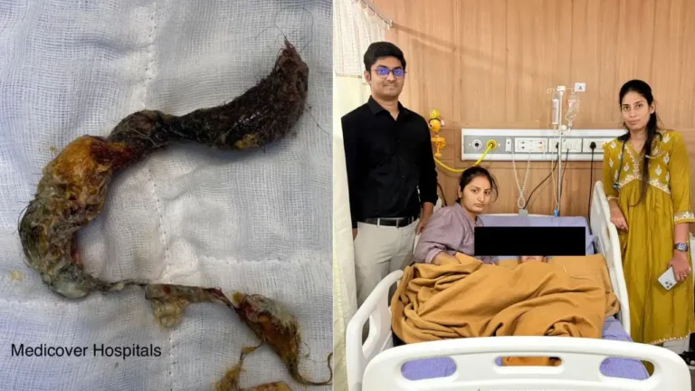 2 ವರ್ಷದ ಮಗುವಿಗೆ ಅಪರೂಪದ ಶಸ್ತ್ರಚಿಕಿತ್ಸೆ: ಹೊಟ್ಟೆಯಿಂದ 480 ಗ್ರಾಂ ಕೂದಲು ಹೊರತೆಗೆದ ವೈದ್ಯರು!