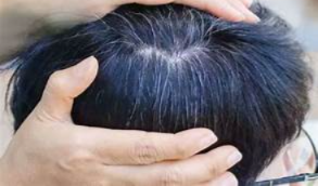 Young Age Grey Hair: 20ರಲ್ಲೇ ಕೂದಲು ಬಿಳಿಯಾಗಲು ಕಾರಣವೇನು?