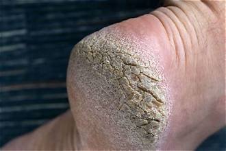 Heel Cracks: ಪಾದದ ಮಡದಿ ಬಿರುಕು ಬಿಡಲು ಕಾರಣವೇನು? ಈ ಆರೈಕೆ ವಿಧಾನ ತಿಳಿಯಿರಿ